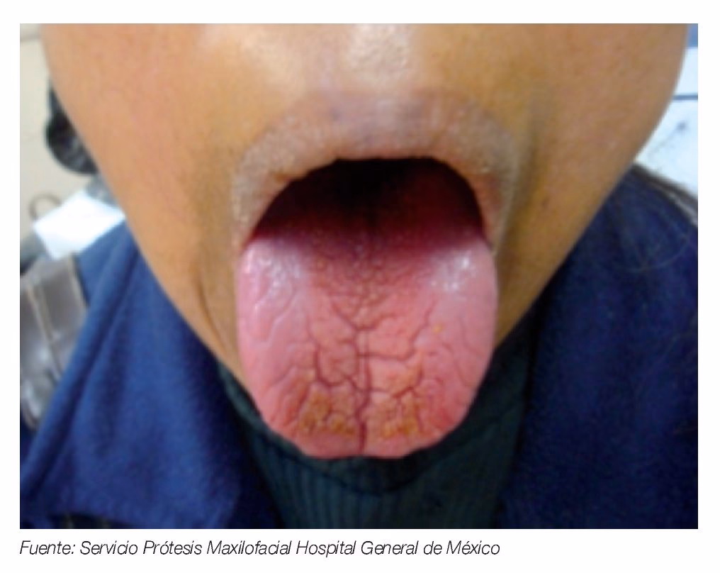 ¿Qué glándula causa la boca seca?