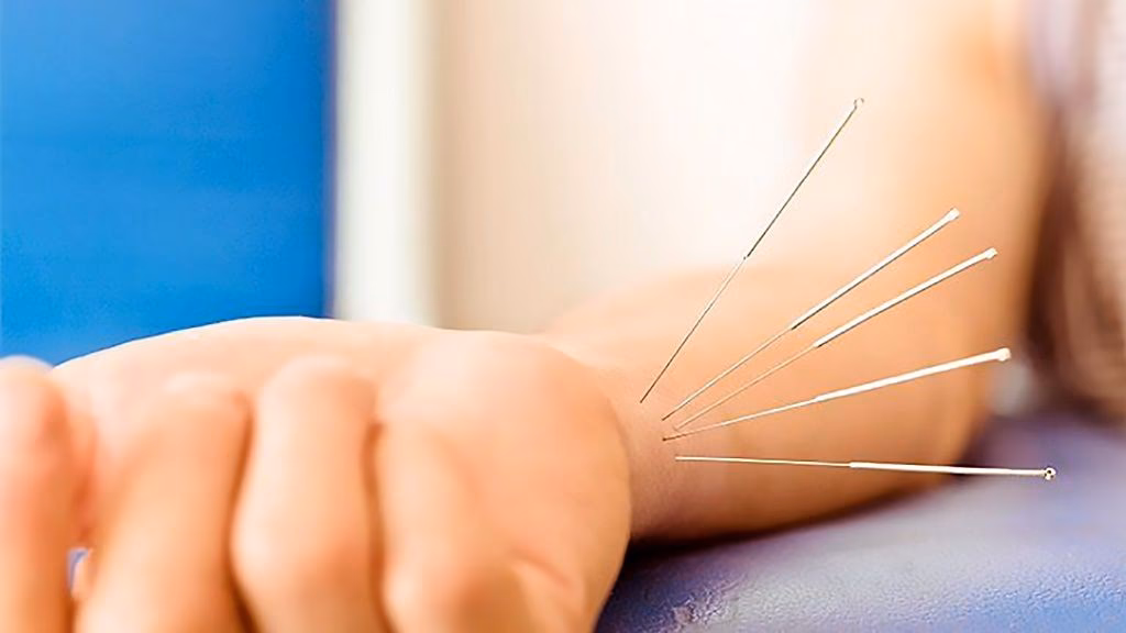 ¿La acupuntura ayuda a la xerostomía?